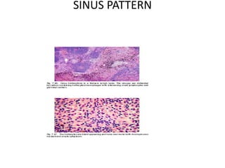 Approach to lymphnode pathology | PPTX