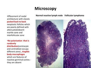 Microscopy
29
Normal reactive lymph node Follicular Lymphoma
•Effacement of nodal
architecture with closely
packed back to back
neoplastic follicles which
are poorly defined with
attenuated/absent
mantle zone and
interfollicular zone
•No polarization that is
randomly
distribution(centrocyte
and centroblast occupy
different zone) , tingible
body macrophages
which are features of
reactive germinal centre.-
they are absent
 