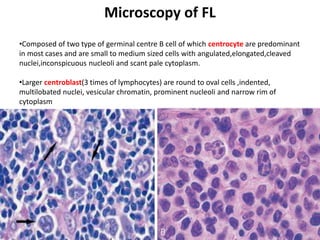 Microscopy of FL
30
Warnke et al
•Composed of two type of germinal centre B cell of which centrocyte are predominant
in most cases and are small to medium sized cells with angulated,elongated,cleaved
nuclei,inconspicuous nucleoli and scant pale cytoplasm.
•Larger centroblast(3 times of lymphocytes) are round to oval cells ,indented,
multilobated nuclei, vesicular chromatin, prominent nucleoli and narrow rim of
cytoplasm
 