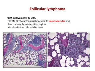 Follicular lymphoma
•In BM FL characteristically localise to paratrabecular and
less commonly to interstitial region.
•In blood same cells can be seen
•BM involvement: 40-70%
 