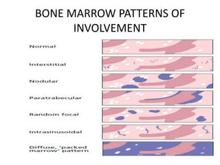 BONE MARROW PATTERNS OF
INVOLVEMENT
 