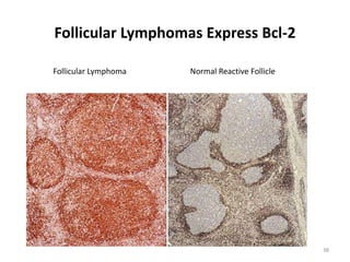 Follicular Lymphomas Express Bcl-2
38
Follicular Lymphoma Normal Reactive Follicle
 