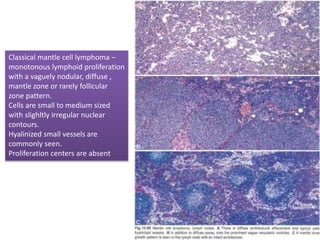 Classical mantle cell lymphoma –
monotonous lymphoid proliferation
with a vaguely nodular, diffuse ,
mantle zone or rarely follicular
zone pattern.
Cells are small to medium sized
with slighltly irregular nuclear
contours.
Hyalinized small vessels are
commonly seen.
Proliferation centers are absent
 