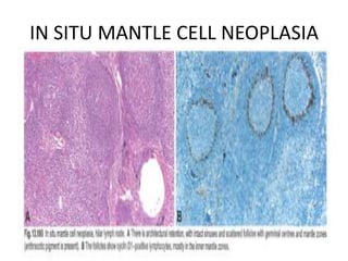 IN SITU MANTLE CELL NEOPLASIA
 