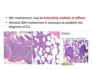 • BM involvement may be interstitial, nodular, or diffuse
• Minimal 30% involvement is necessary to establish the
diagnosis of CLL.
 