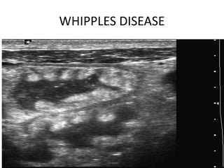 WHIPPLES DISEASE
 