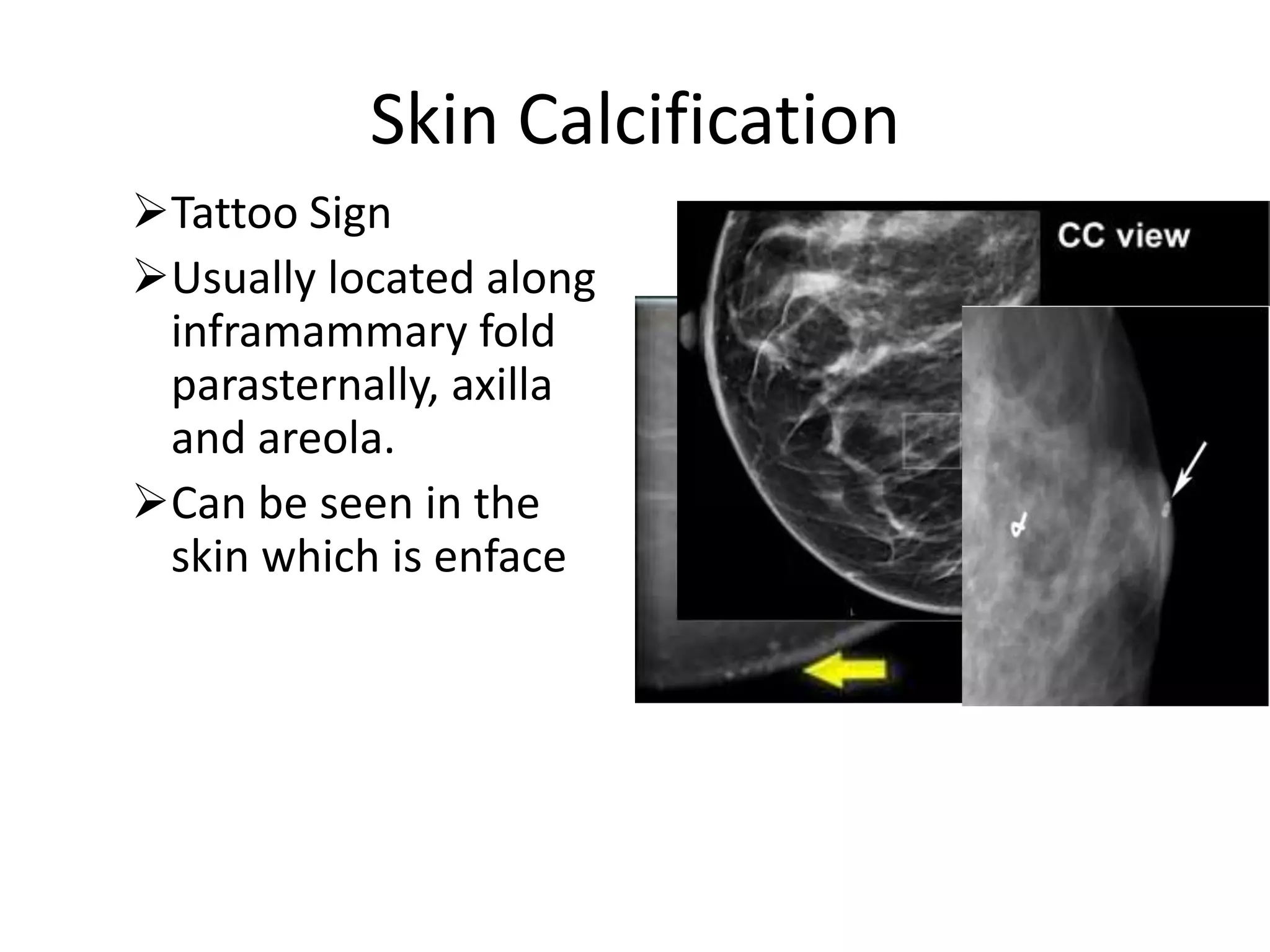 Skin Calcification
Tattoo Sign
Usually located along
inframammary fold
parasternally, axilla
and areola.
Can be seen in the
skin which is enface

 
