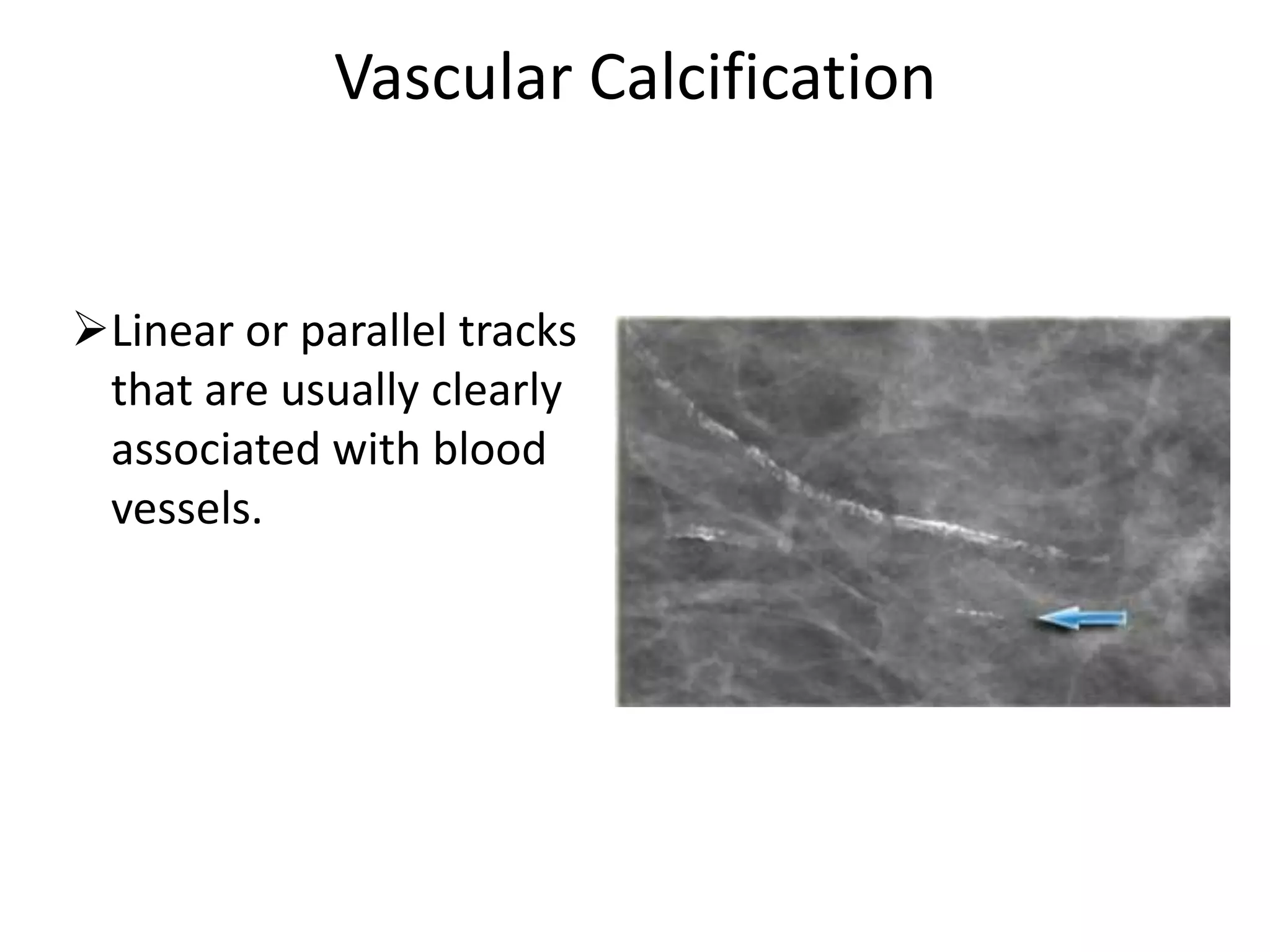 Vascular Calcification

Linear or parallel tracks
that are usually clearly
associated with blood
vessels.

 