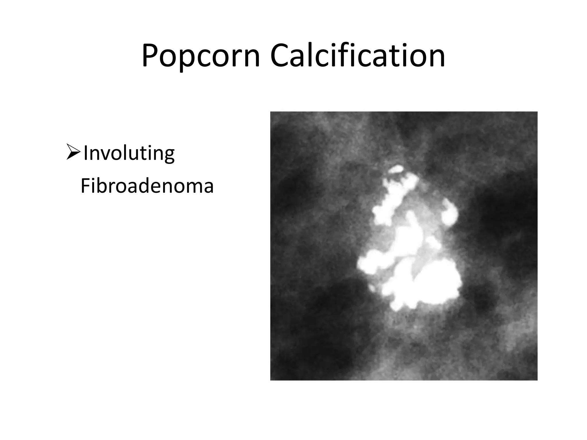 Popcorn Calcification
Involuting
Fibroadenoma

 