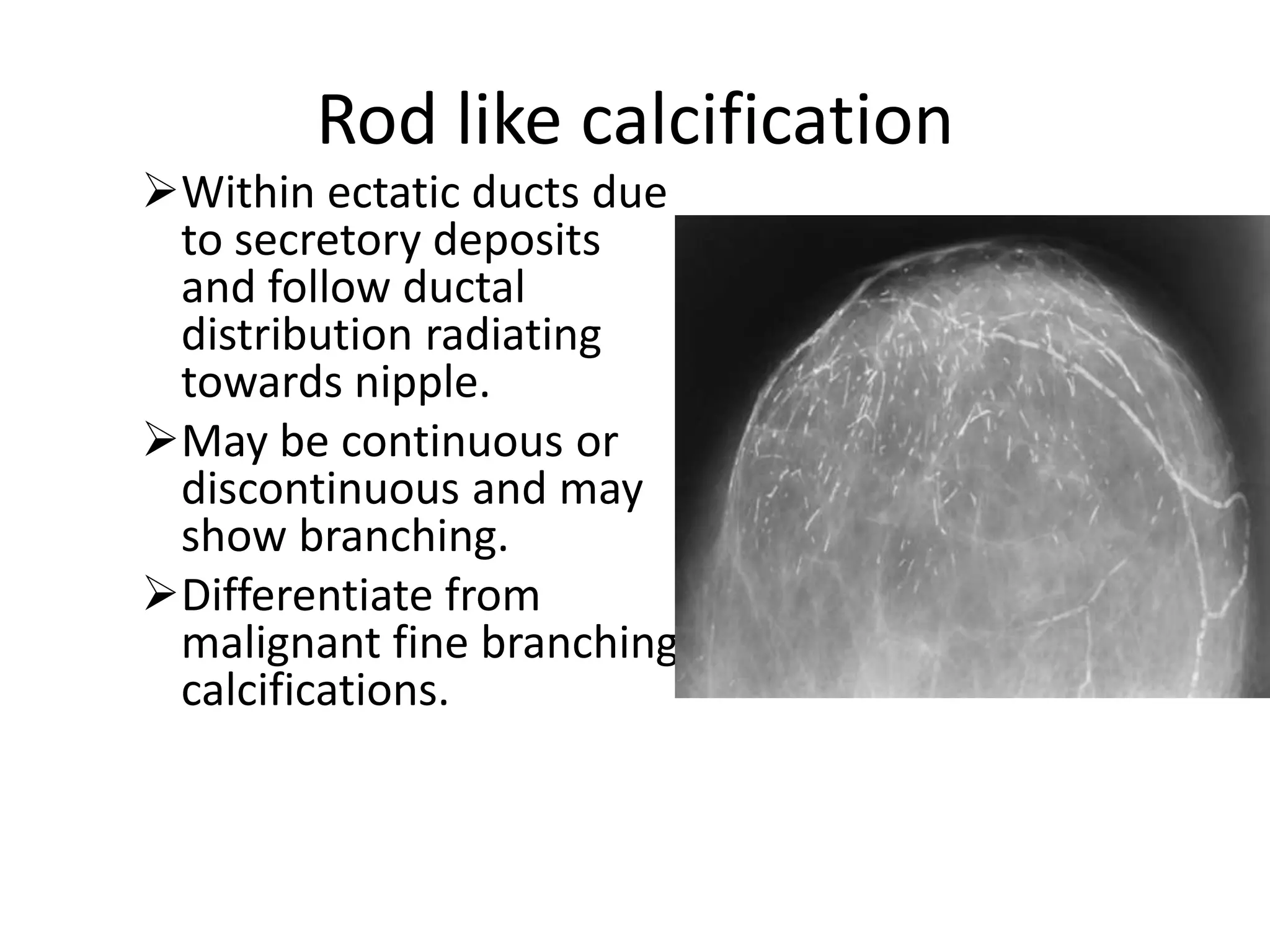 Rod like calcification
Within ectatic ducts due
to secretory deposits
and follow ductal
distribution radiating
towards nipple.
May be continuous or
discontinuous and may
show branching.
Differentiate from
malignant fine branching
calcifications.

 