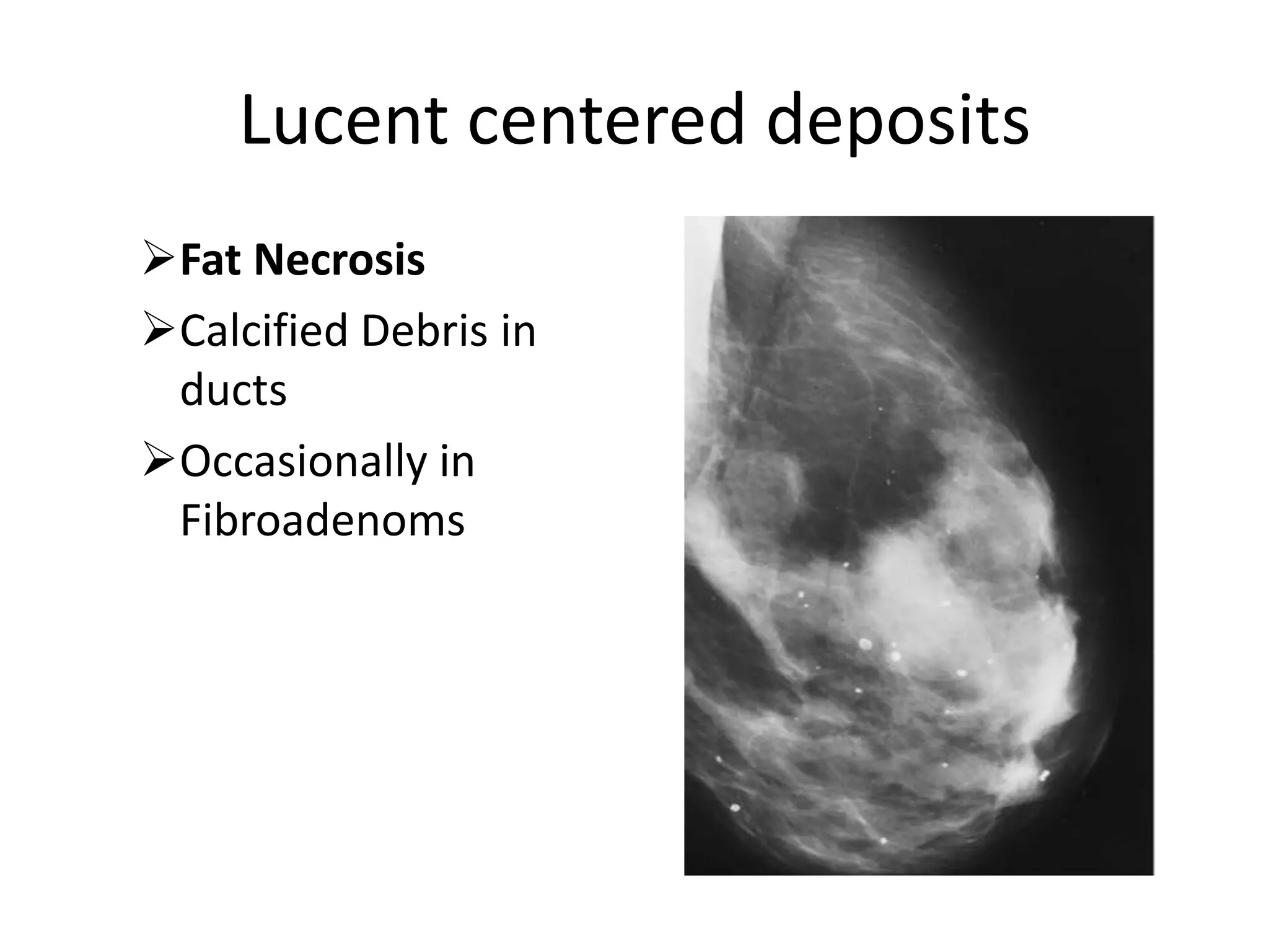 Lucent centered deposits
Fat Necrosis
Calcified Debris in
ducts
Occasionally in
Fibroadenoms

 