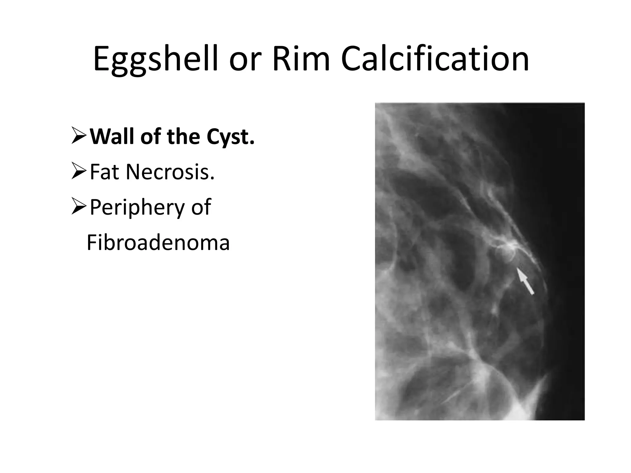 Eggshell or Rim Calcification
Wall of the Cyst.
Fat Necrosis.
Periphery of
Fibroadenoma

 