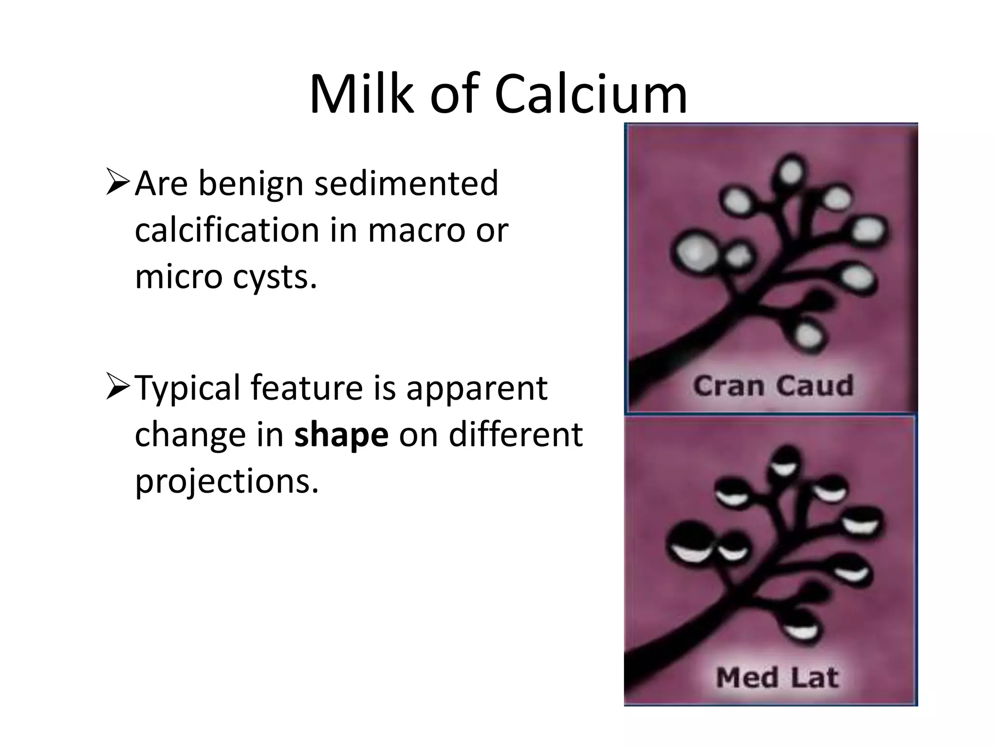 Milk of Calcium
Are benign sedimented
calcification in macro or
micro cysts.
Typical feature is apparent
change in shape on different
projections.

 