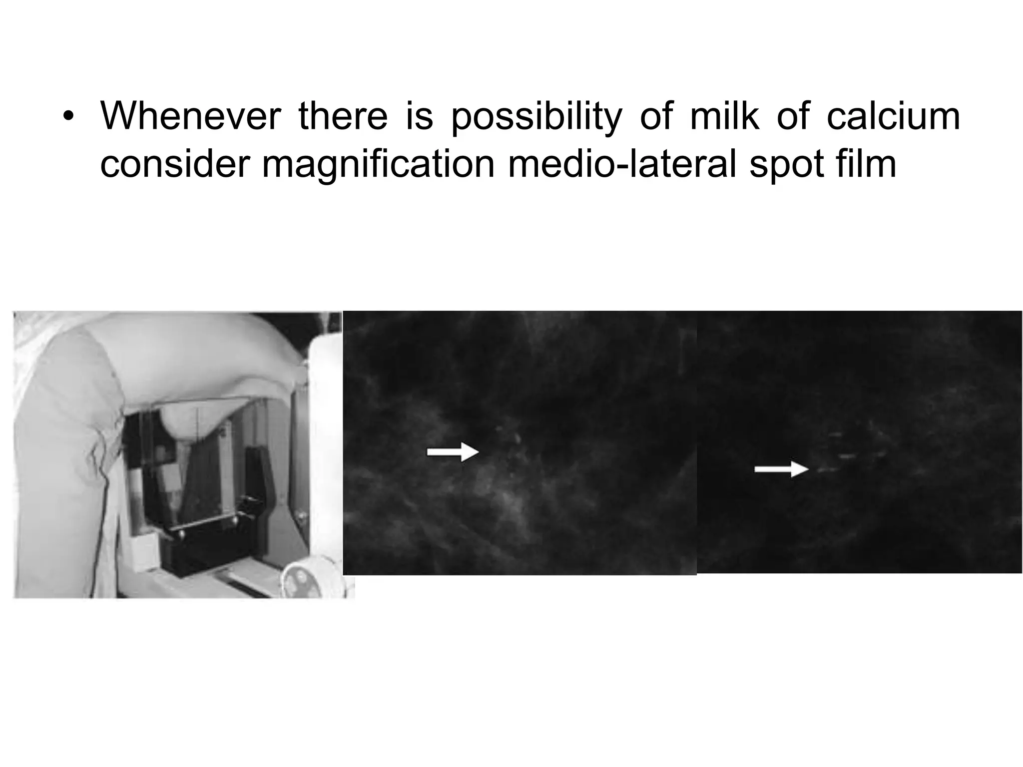 • Whenever there is possibility of milk of calcium
consider magnification medio-lateral spot film

 