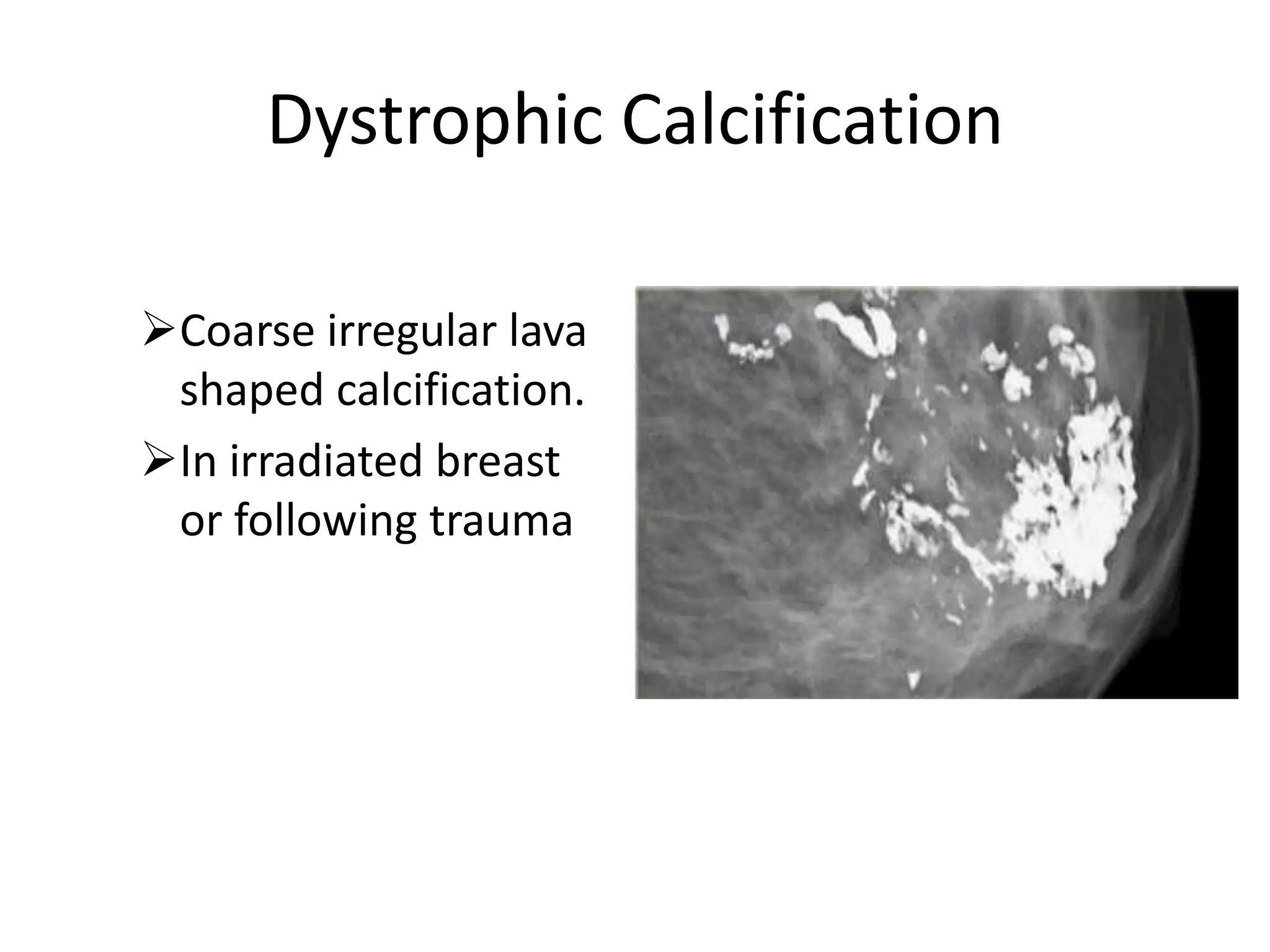 Dystrophic Calcification
Coarse irregular lava
shaped calcification.
In irradiated breast
or following trauma

 