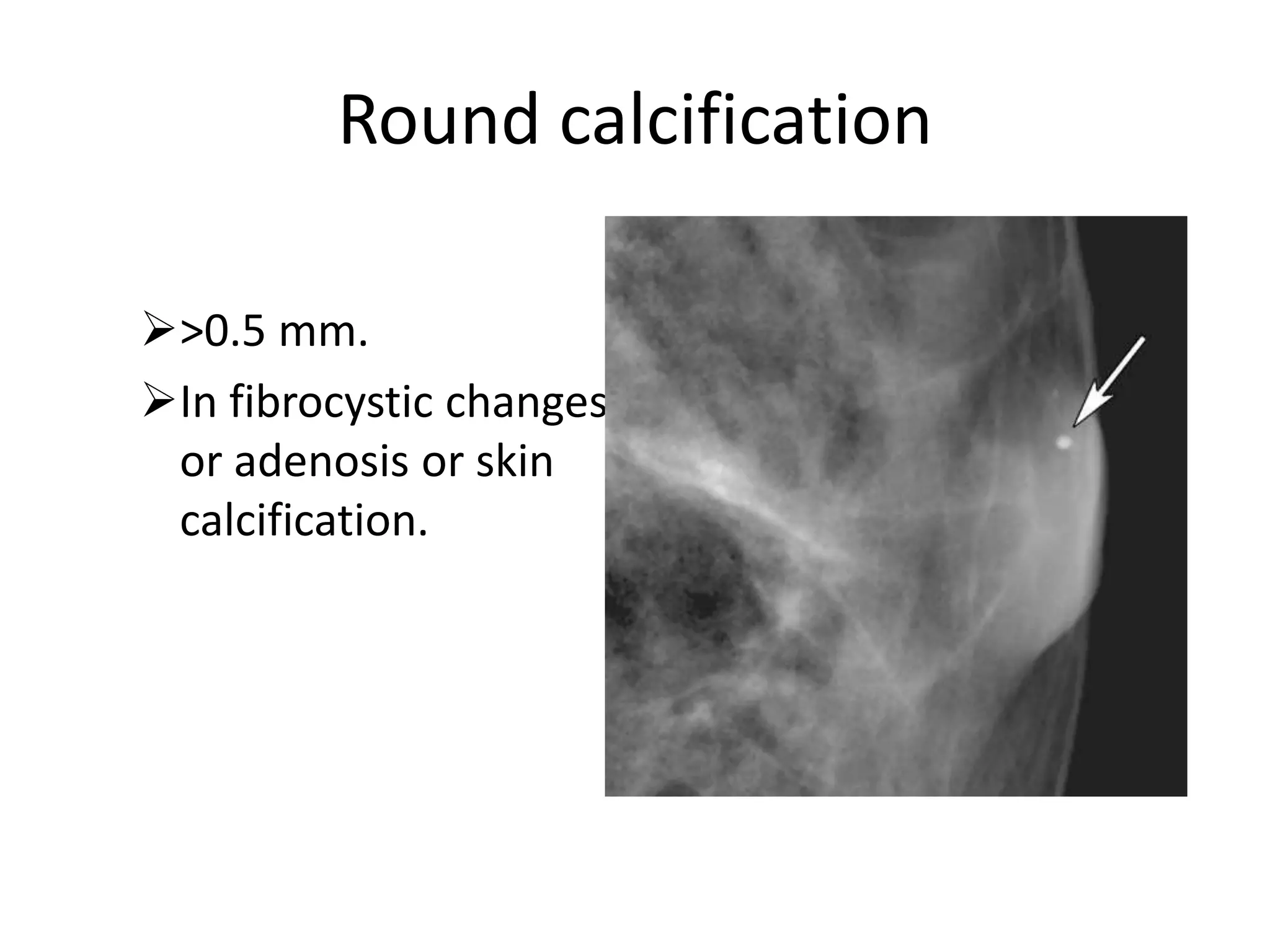 Round calcification
>0.5 mm.
In fibrocystic changes
or adenosis or skin
calcification.

 