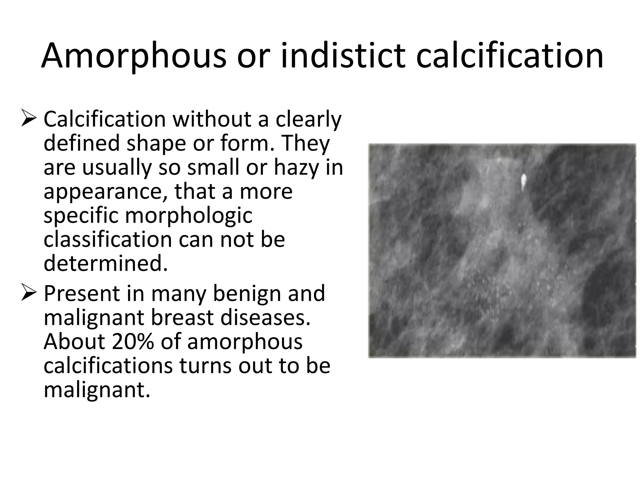 Amorphous or indistict calcification
 Calcification without a clearly
defined shape or form. They
are usually so small or hazy in
appearance, that a more
specific morphologic
classification can not be
determined.
 Present in many benign and
malignant breast diseases.
About 20% of amorphous
calcifications turns out to be
malignant.

 