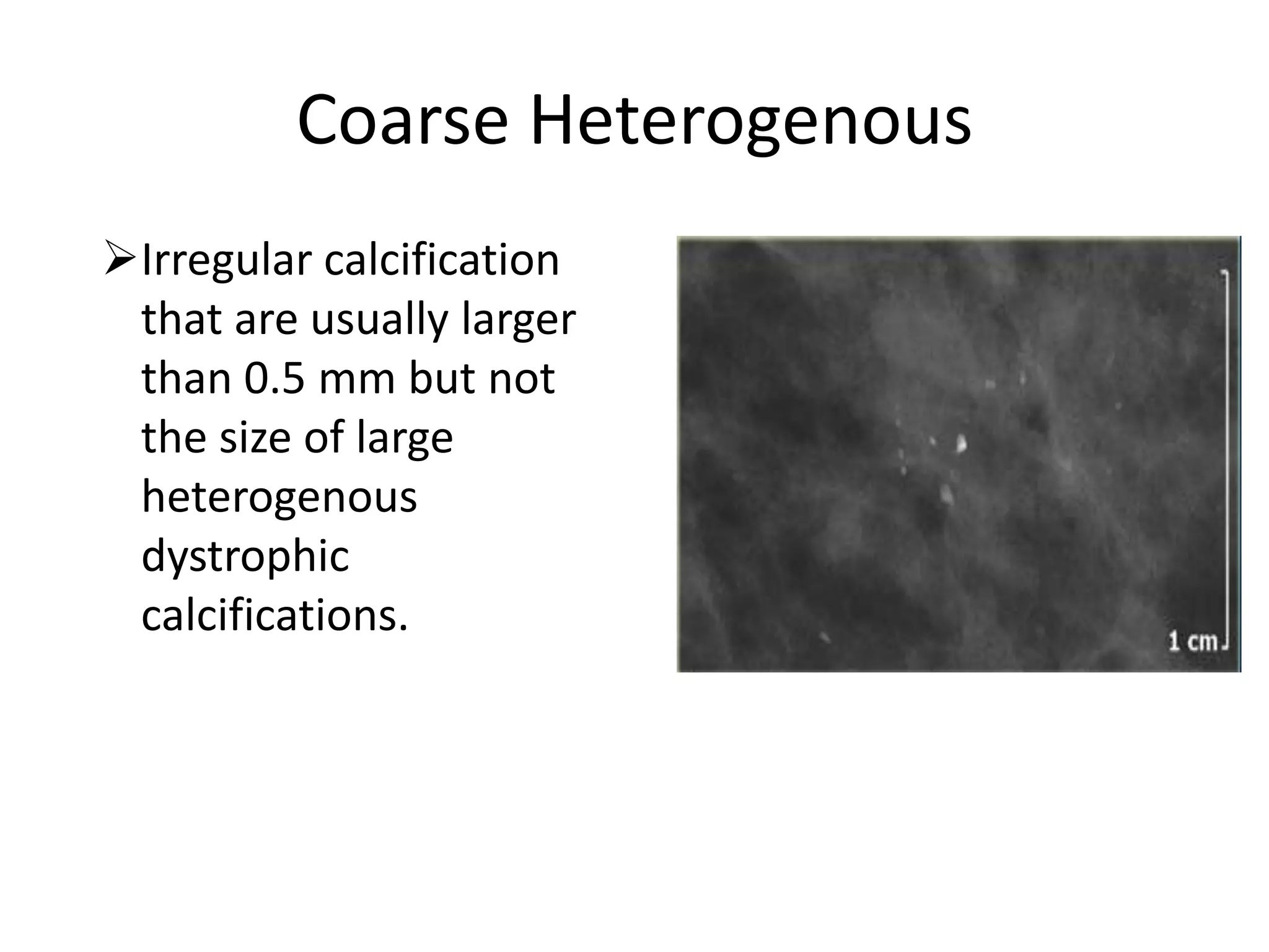 Coarse Heterogenous
Irregular calcification
that are usually larger
than 0.5 mm but not
the size of large
heterogenous
dystrophic
calcifications.

 