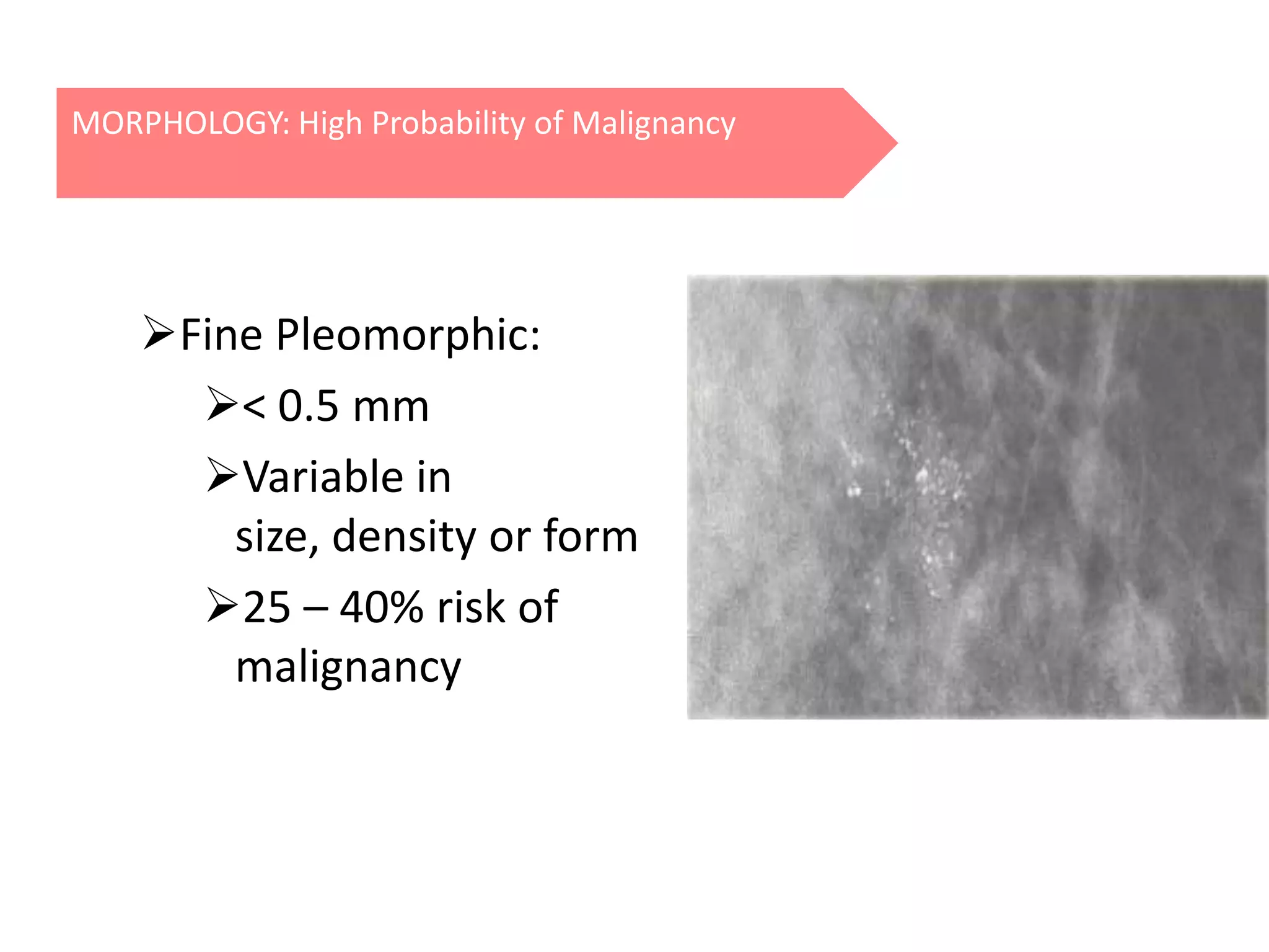 MORPHOLOGY: High Probability of Malignancy

Fine Pleomorphic:
< 0.5 mm
Variable in
size, density or form
25 – 40% risk of
malignancy

 
