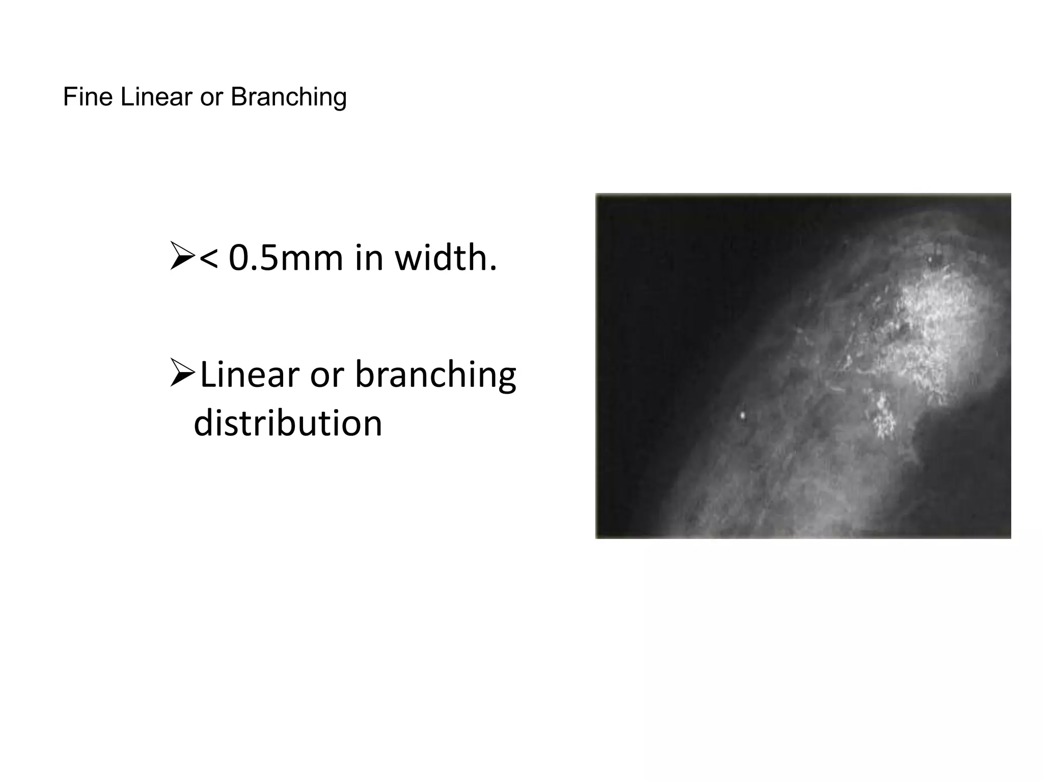 Fine Linear or Branching

< 0.5mm in width.
Linear or branching
distribution

 