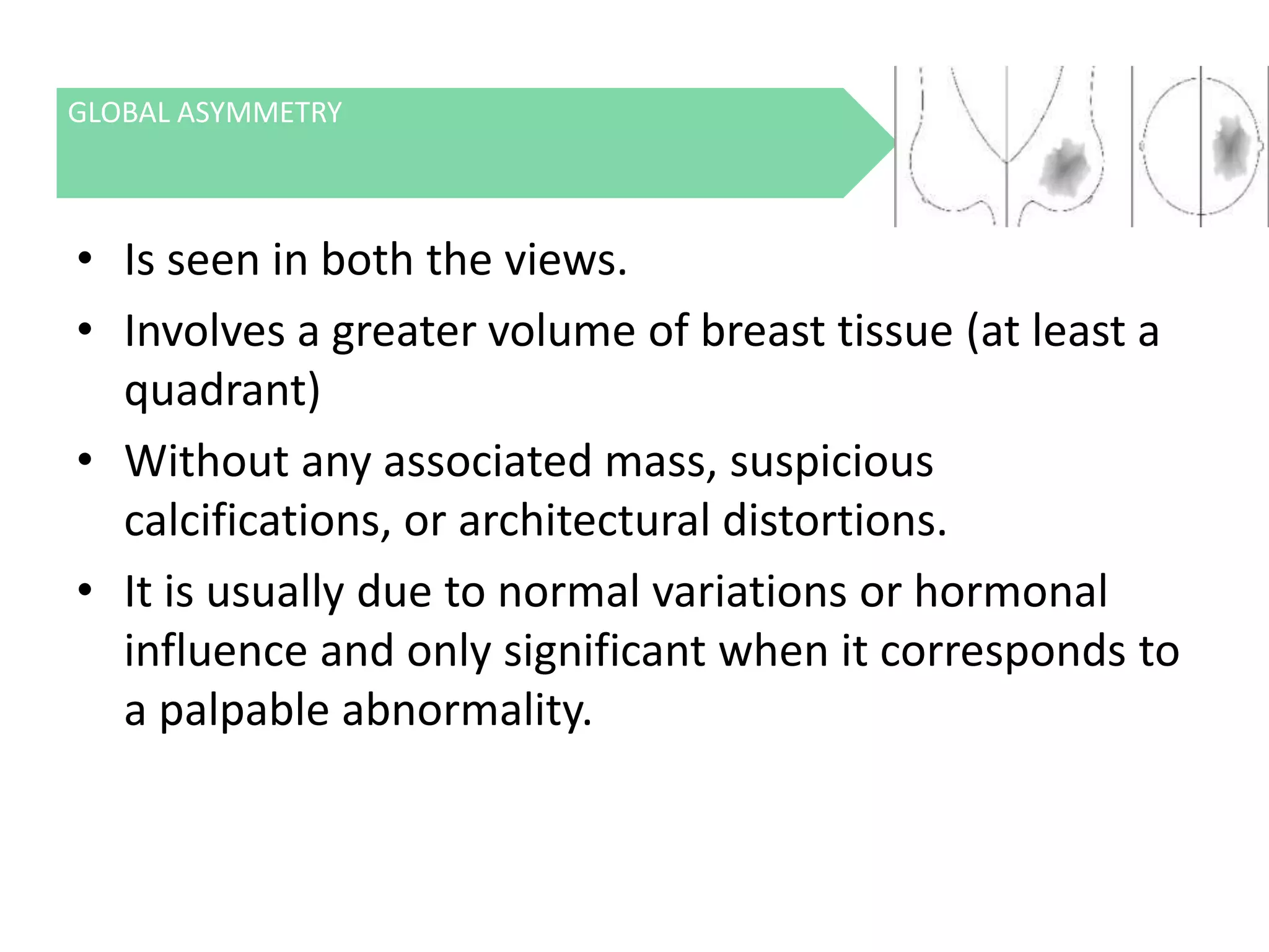 GLOBAL ASYMMETRY

• Is seen in both the views.
• Involves a greater volume of breast tissue (at least a
quadrant)
• Without any associated mass, suspicious
calcifications, or architectural distortions.
• It is usually due to normal variations or hormonal
influence and only significant when it corresponds to
a palpable abnormality.

 