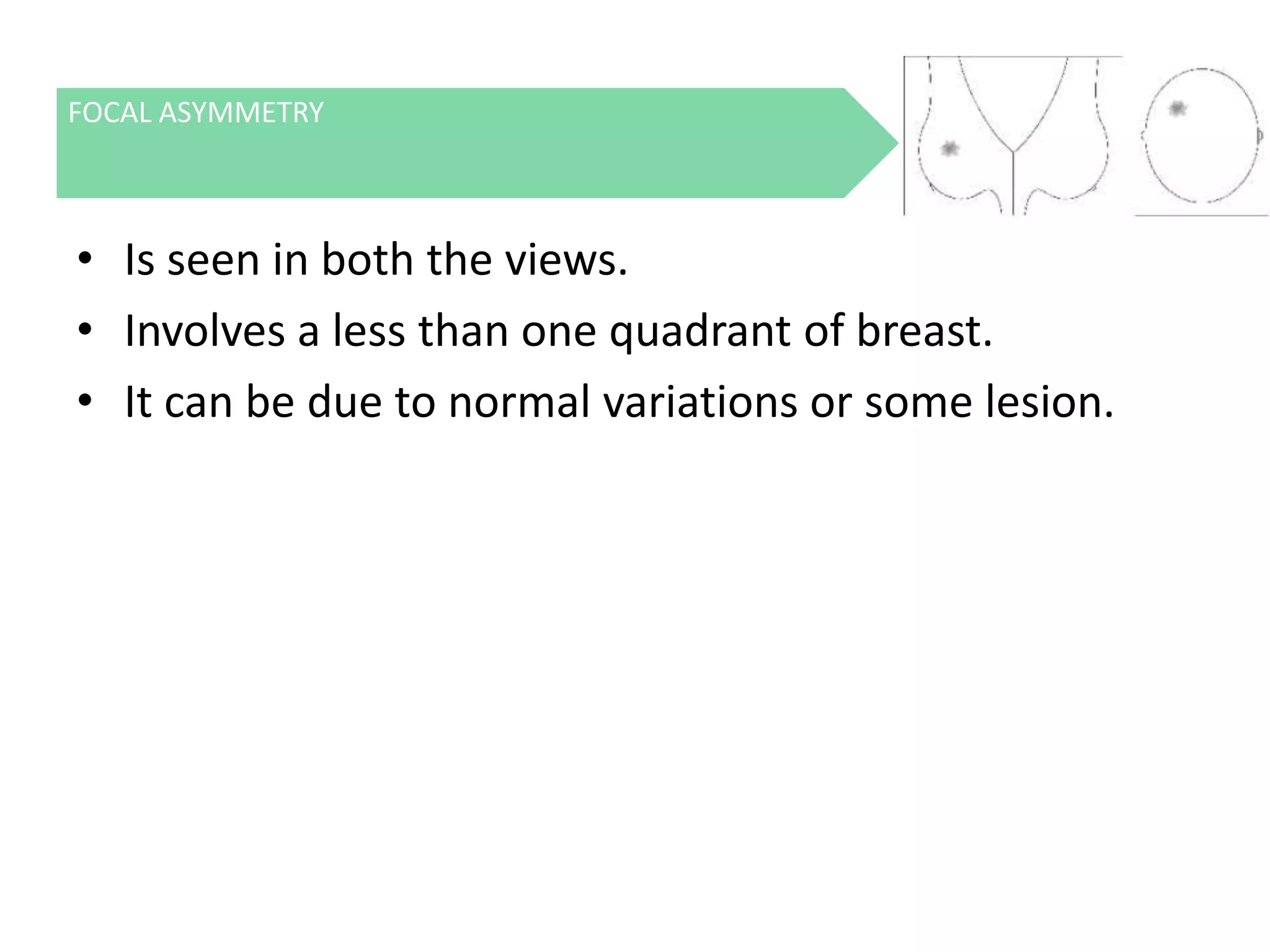 FOCAL ASYMMETRY

• Is seen in both the views.
• Involves a less than one quadrant of breast.
• It can be due to normal variations or some lesion.

 