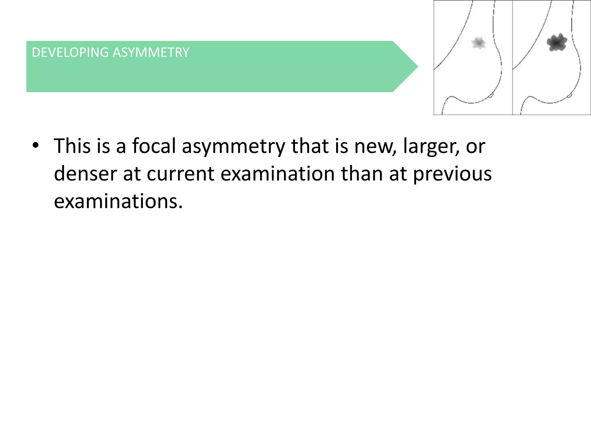 DEVELOPING ASYMMETRY

• This is a focal asymmetry that is new, larger, or
denser at current examination than at previous
examinations.

 