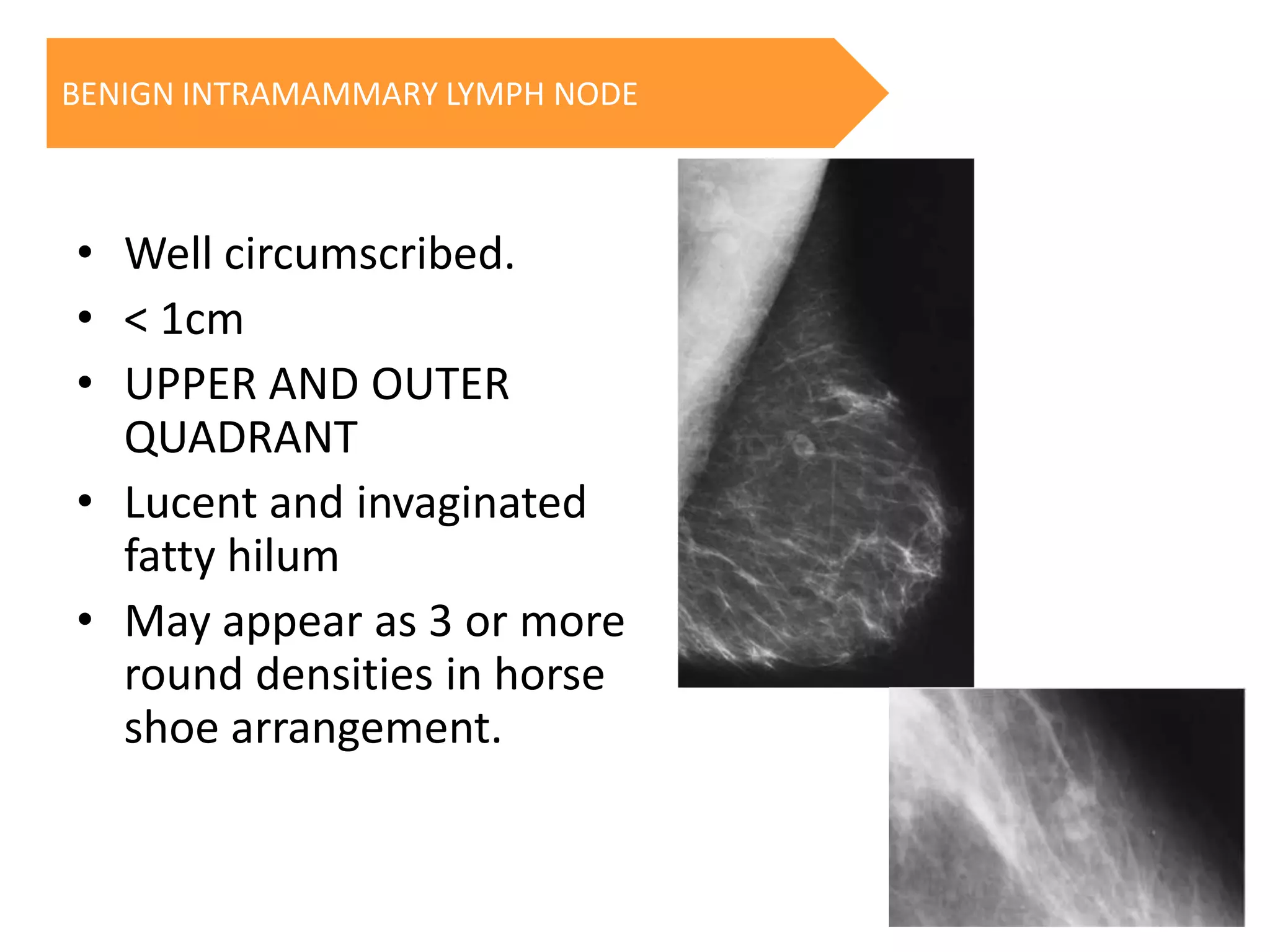 BENIGN INTRAMAMMARY LYMPH NODE

• Well circumscribed.
• < 1cm
• UPPER AND OUTER
QUADRANT
• Lucent and invaginated
fatty hilum
• May appear as 3 or more
round densities in horse
shoe arrangement.

 