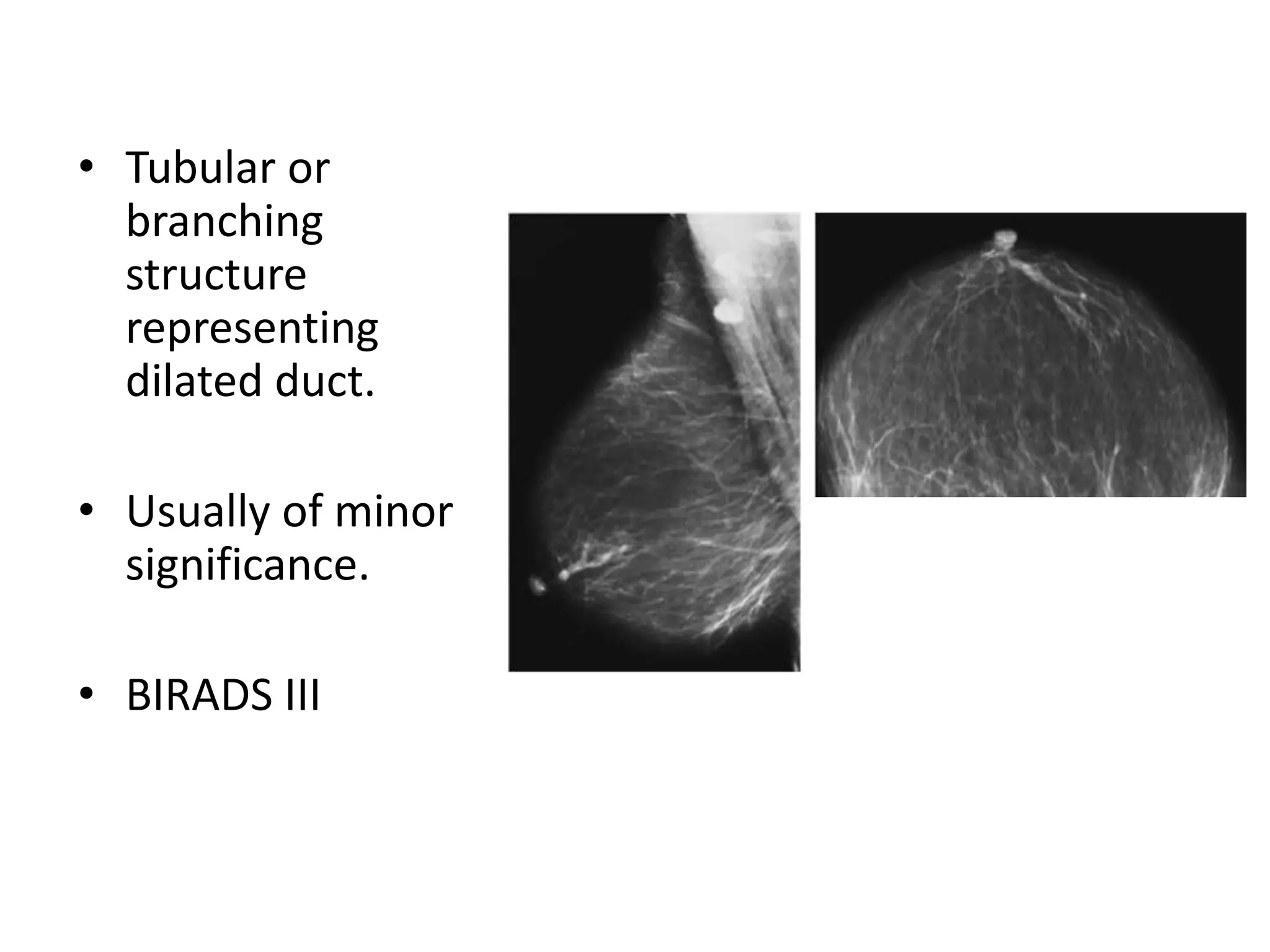 • Tubular or
branching
structure
representing
dilated duct.
• Usually of minor
significance.
• BIRADS III

 