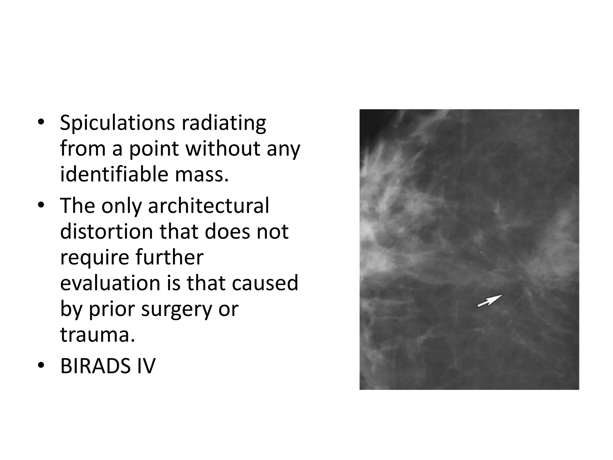 • Spiculations radiating
from a point without any
identifiable mass.
• The only architectural
distortion that does not
require further
evaluation is that caused
by prior surgery or
trauma.
• BIRADS IV

 