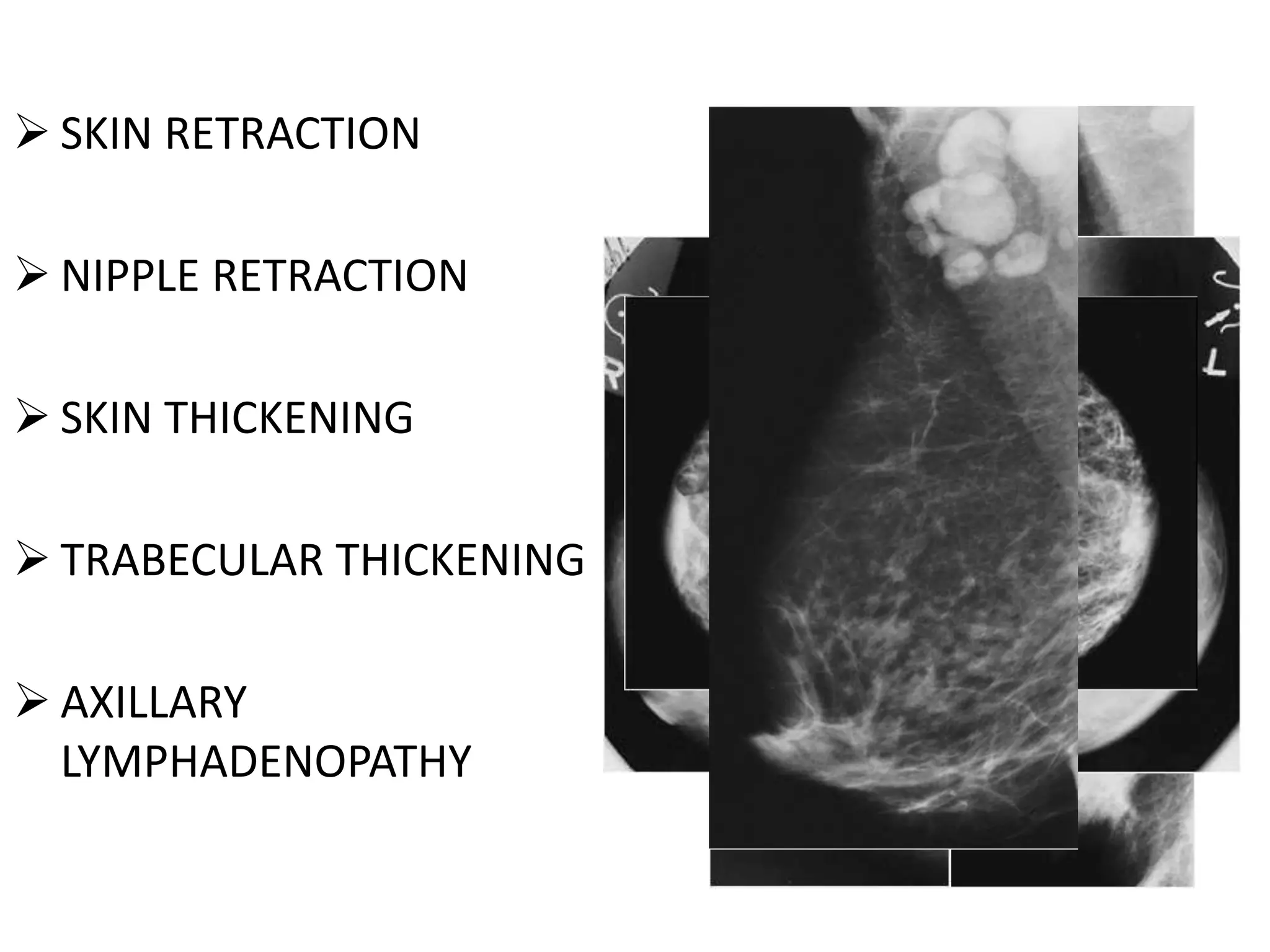  SKIN RETRACTION
 NIPPLE RETRACTION

 SKIN THICKENING
 TRABECULAR THICKENING
 AXILLARY
LYMPHADENOPATHY

 