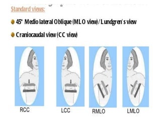 Mammogram Slides approach to mammogram.ppt