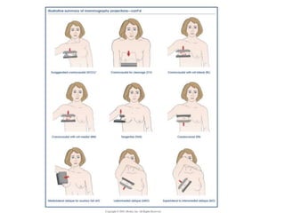 Mammogram Slides approach to mammogram.ppt