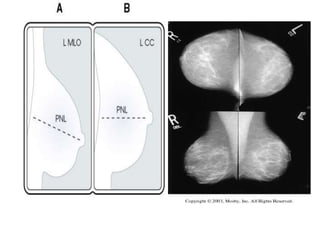 Mammogram Slides approach to mammogram.ppt