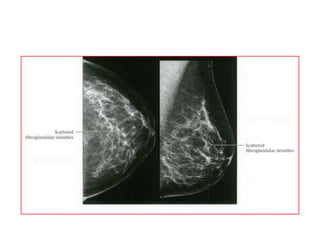 Mammogram Slides approach to mammogram.ppt