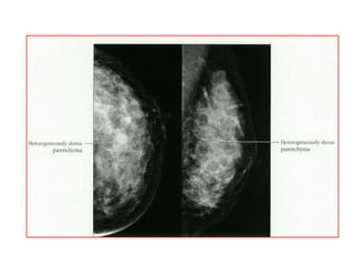 Mammogram Slides approach to mammogram.ppt