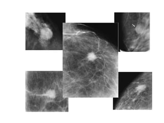 Mammogram Slides approach to mammogram.ppt