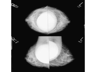 Mammogram Slides approach to mammogram.ppt