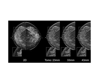 Mammogram Slides approach to mammogram.ppt