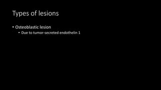 Types of lesions
• Osteoblastic lesion
• Due to tumor-secreted endothelin 1
 