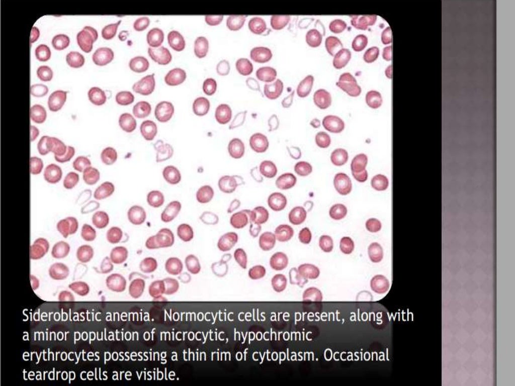 Approach to microcytic hypochromic anemia