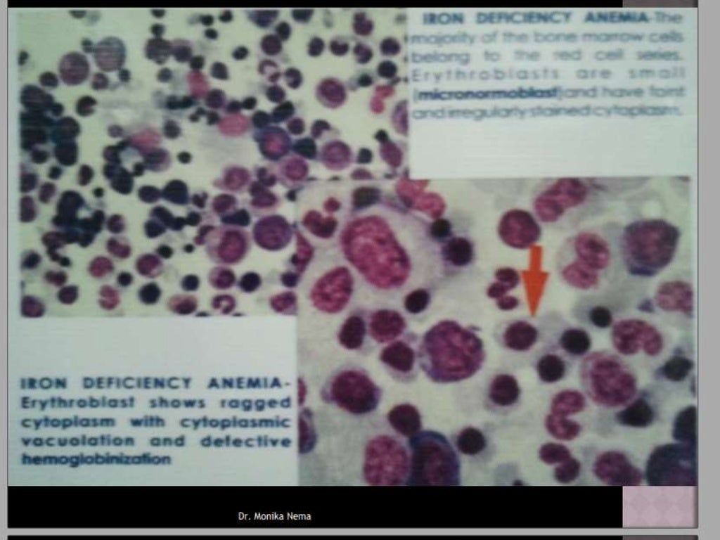Approach to microcytic hypochromic anemia