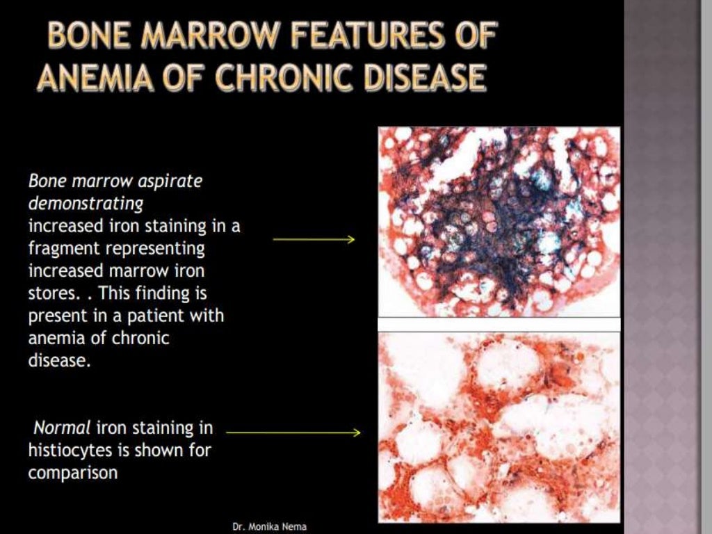 Approach to microcytic hypochromic anemia