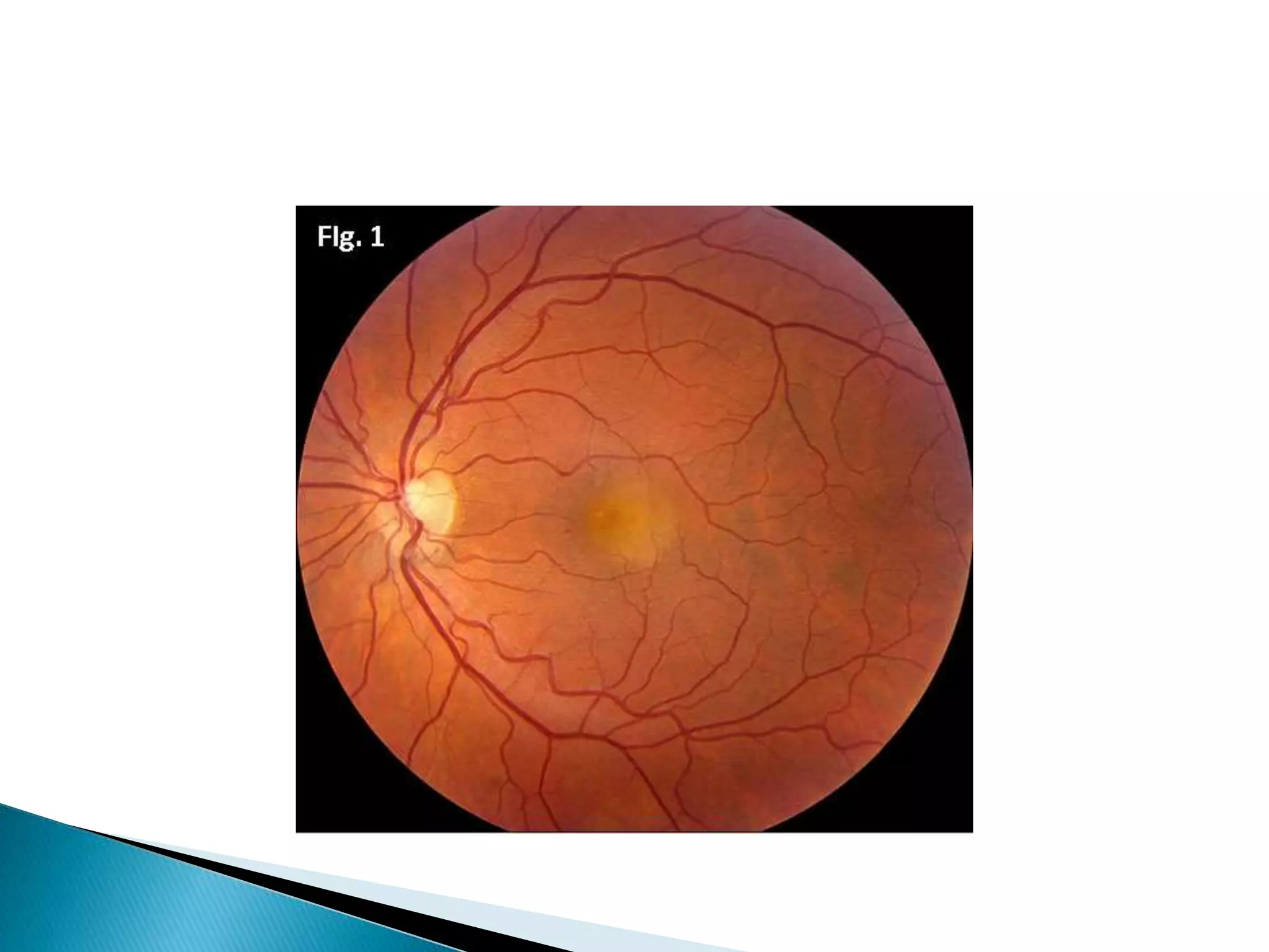 Approach to monocular blindness