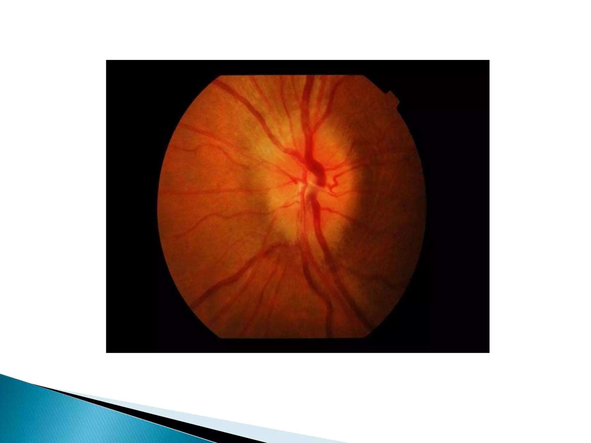 Approach to monocular blindness