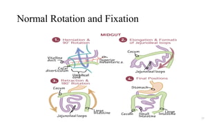 Normal Intestinal Rotation Diagram Approach to Neonatal Intestinal Obstruction.pptx