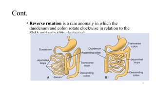 Approach to Neonatal Intestinal Obstruction.pptx