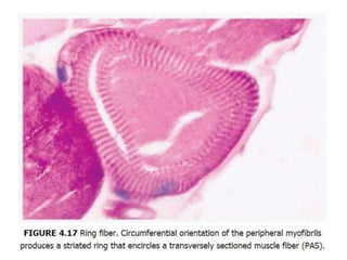 Subfibrillose Rings Approach to neuromuscular disorders | PPTX