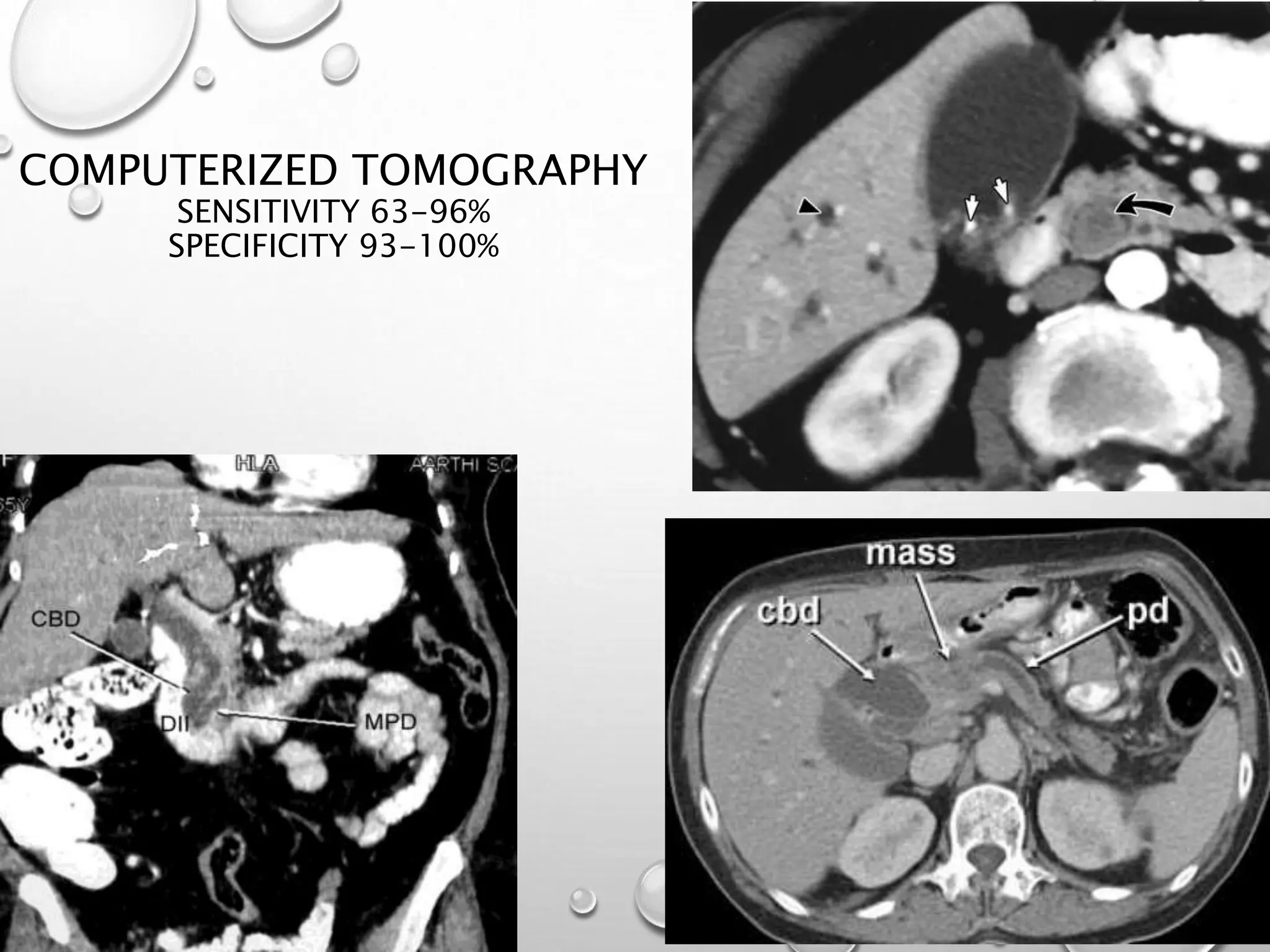 COMPUTERIZED TOMOGRAPHY
SENSITIVITY 63-96%
SPECIFICITY 93-100%
 