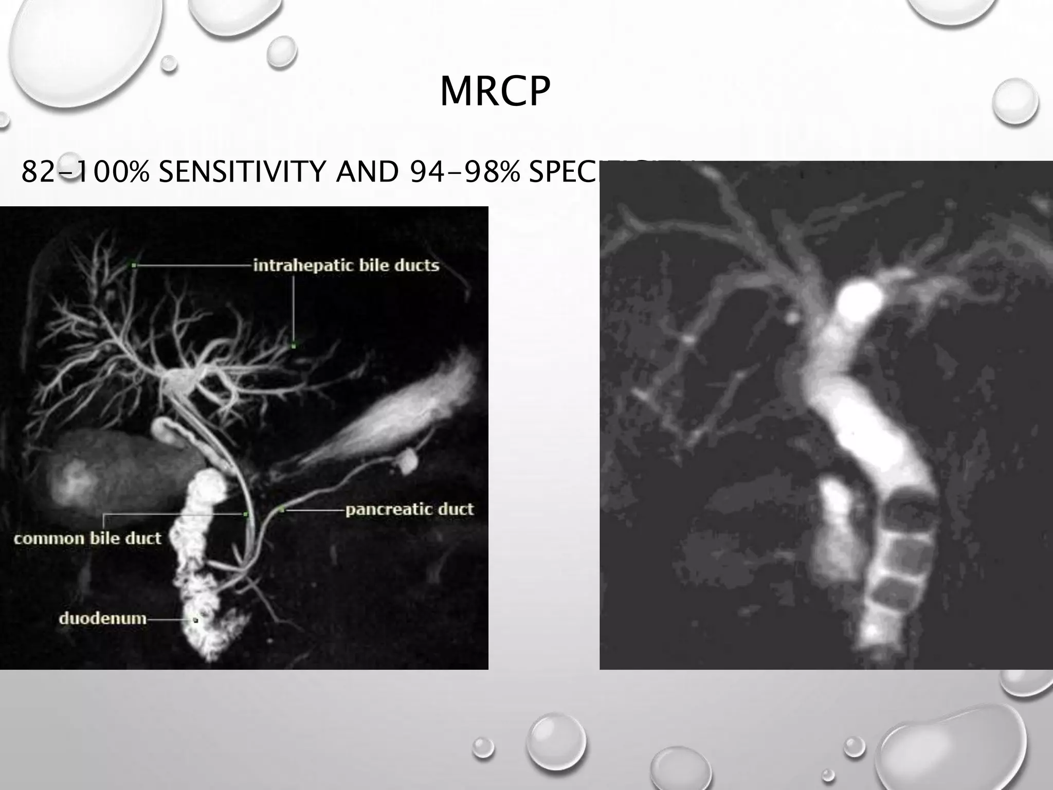 82-100% SENSITIVITY AND 94-98% SPECIFICITY
MRCP
 
